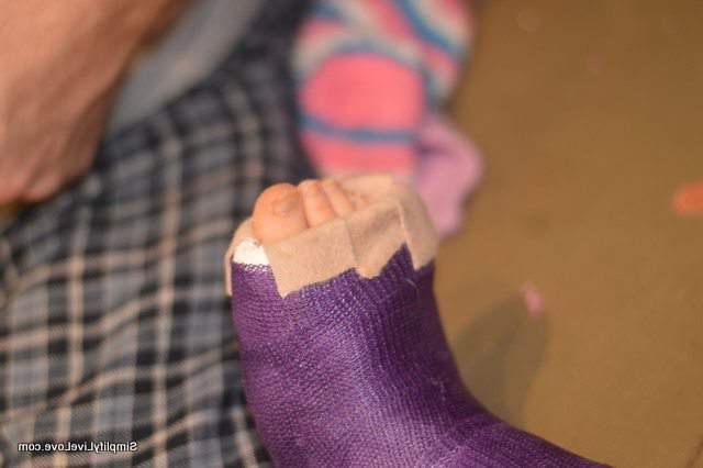 toe in the reclining spica cast